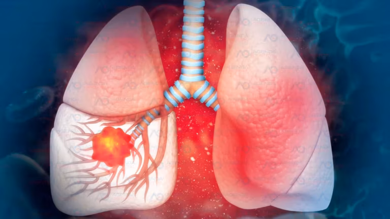 Humo que mata: 80% cáncer pulmón se asocia al tabaco