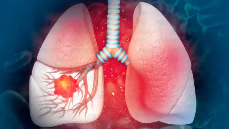 Humo que mata: 80% cáncer pulmón se asocia al tabaco